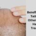 Benefits of Scalp Tattoos and Other Cosmetic Hair Loss Treatments