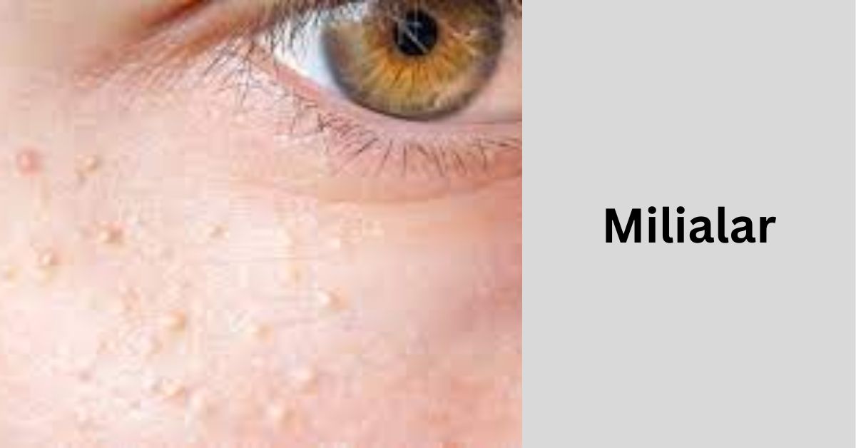 Milialar - Causes And Symptoms From Professional's Guide