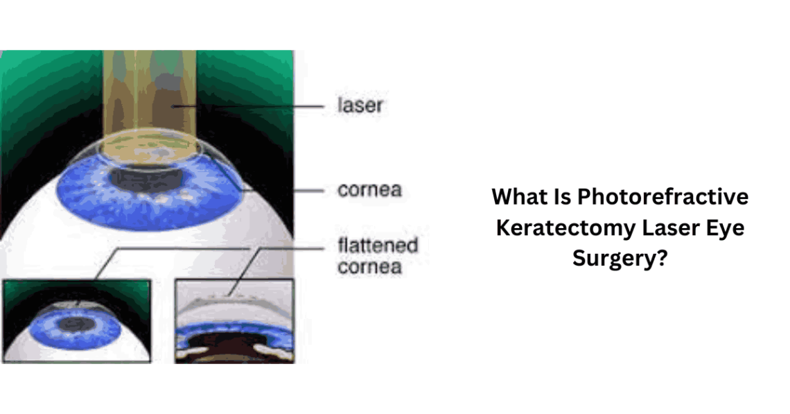 What Is Photorefractive Keratectomy Laser Eye Surgery