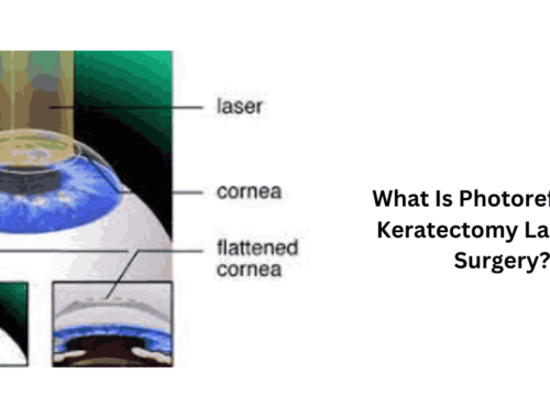 What Is Photorefractive Keratectomy Laser Eye Surgery